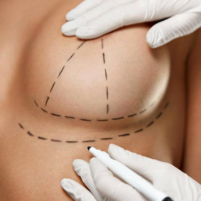 Instytut Bielenda Liposukcja i powiększanie piersi