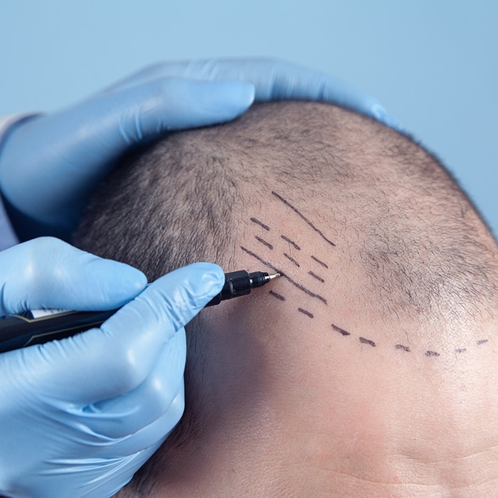 Instytut Bielenda przeszczep włosów