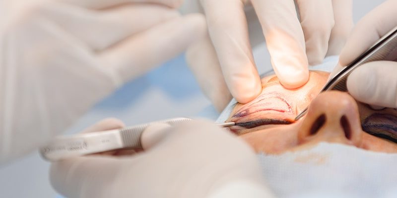 Instytut Bielenda Plastyka powiek