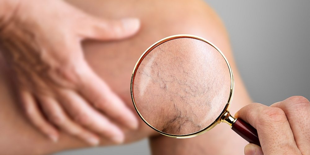 Czy twoje żyły są w dobrym stanie